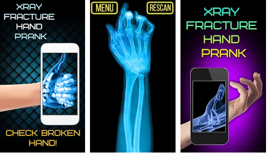 x-ray fractured hand prank